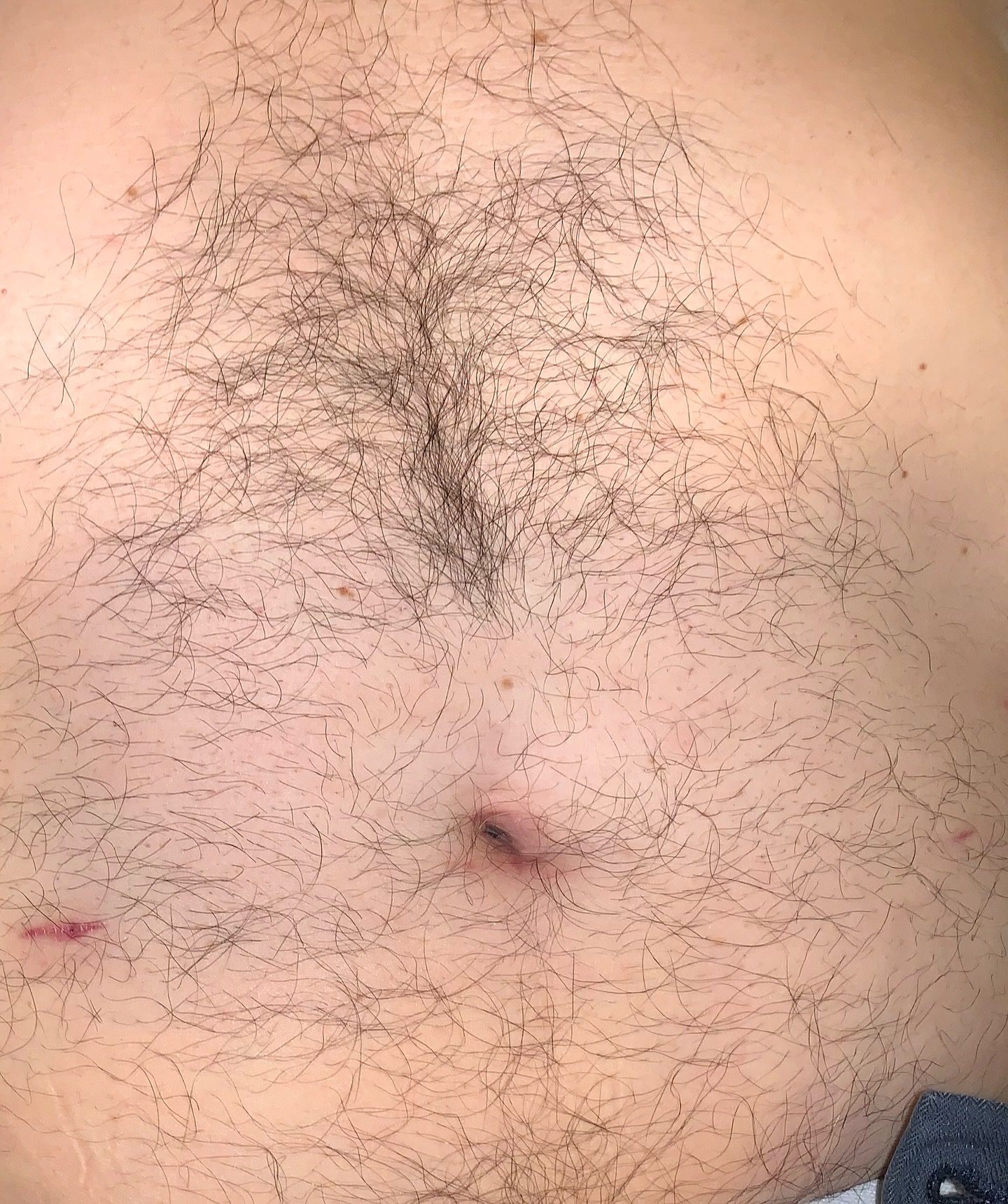 hernia2